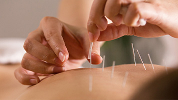 patient getting acupuncture in Oklahoma City OK