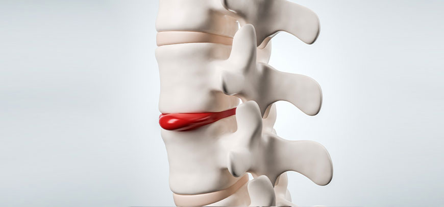 patient receiving herniated disc in Oklahoma City