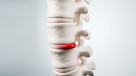 patient requiring disc injury treatment in Oklahoma City