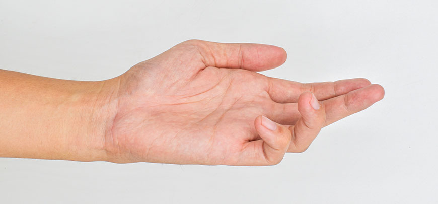 patient needing dupuytren contracture treatment in Oklahoma City