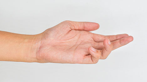 patient requiring dupuytren contracture treatment in Oklahoma City