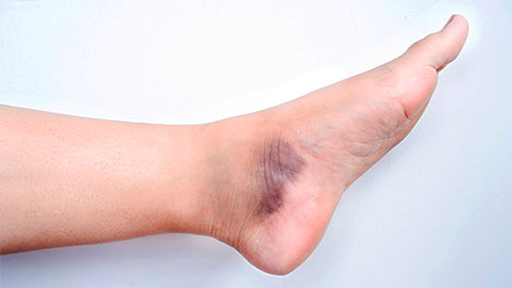 patient requiring sprain treatment in Oklahoma City