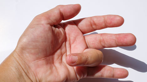 patient requiring trigger finger treatment in Oklahoma City